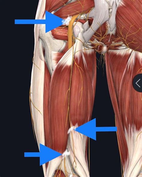 ischial compression test|NERVE ENTRAPMENT IN THE HIP REGION: CURRENT .